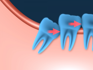 Bite Sized Wisdom- Knowing the Facts on Wisdom Teeth