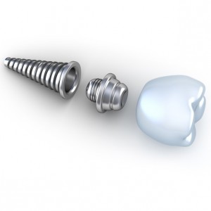 Dental Implant e