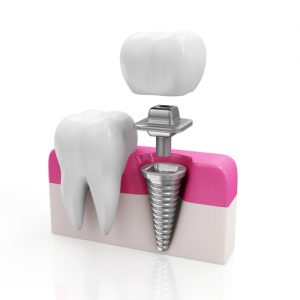 Dental Implants-High Tech Teeth