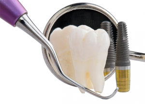 Dental lmplants vs Dentures