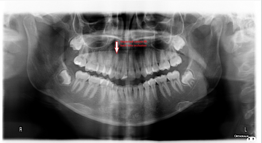 Dr massoomi with impacted canine back in