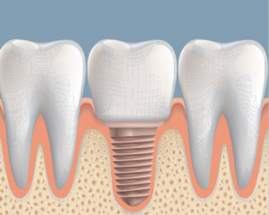 'implant between teeth'