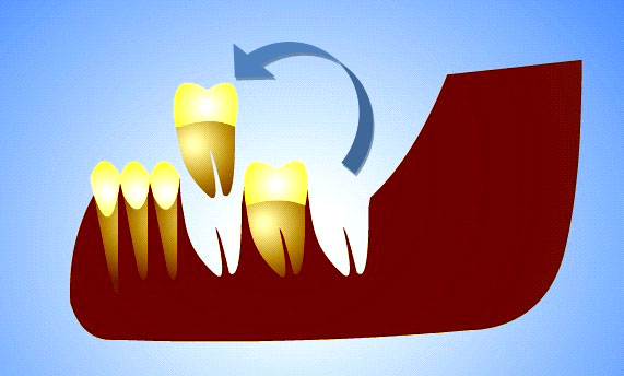 Tooth Autotransplantation Dr Massoomi