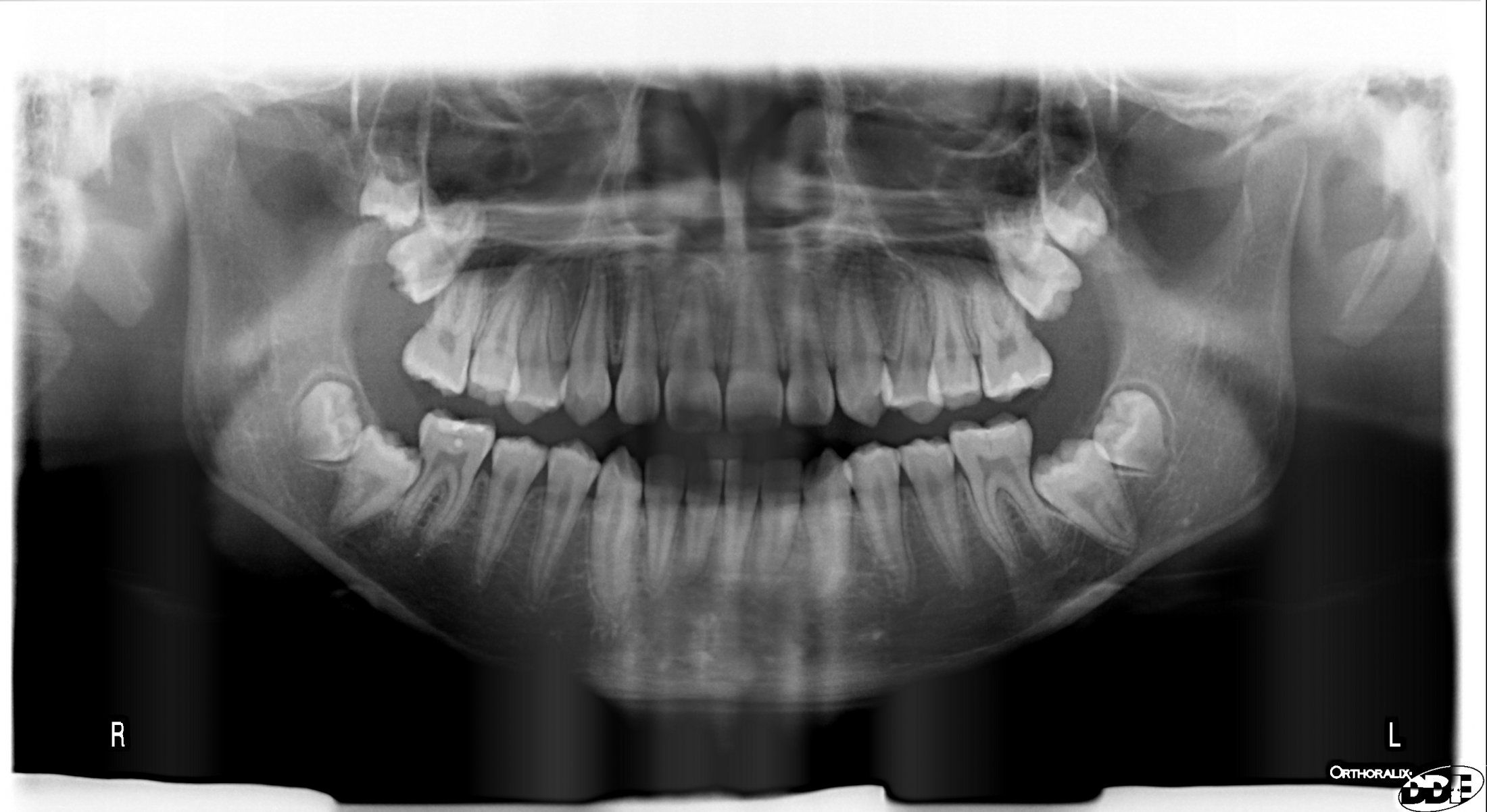 Cost Of Dental X Rays And Cleaning Without Insurance