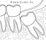 removing-wisdom-teeth