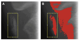 Panorex of Carotid artery calcification