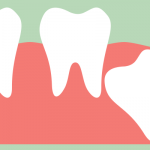 Wisdom teeth removal is one of the San Francisco oral surgery options offered by Dr. Massomi.