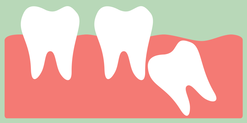 Wisdom Tooth Management - Dr. Massoomi - Bay Area Dentist