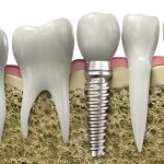 San Francisco oral surgeon Dr. Massoomi offers dental implants.