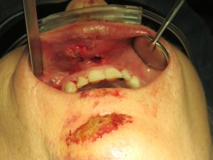 Orthognathic Surgery process in Cupertino - part 3