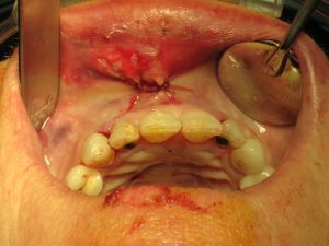 Orthognathic Surgery process in Cupertino - part 4