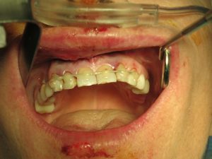 Orthognathic Surgery process in Cupertino - part 5