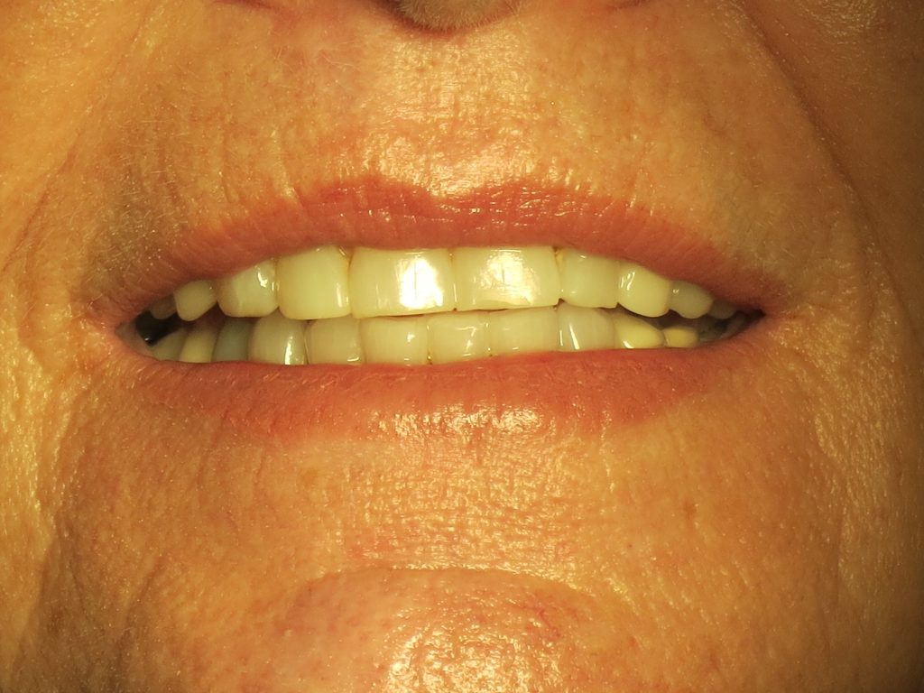 All About Jaw Fractures Dr. Nima Massoomi DMD MEd MD