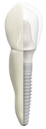 Dental Implant Surgery by Dr Massooomi in Cupertino, CA