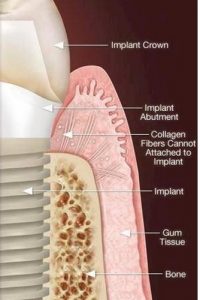 Dental Implants from Dr Massoomi in San Francisco, CA