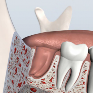 Empty socket after a tooth extraction in Cupertino.