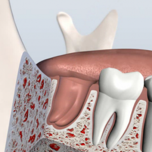 Empty socket after a tooth extraction in San Francisco.