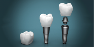 An image of an implant attached to a tooth showing how implants are structured.