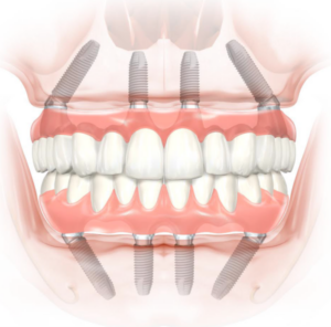 Full arch dental implants graphic