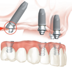 Full arch dental implants side profile.