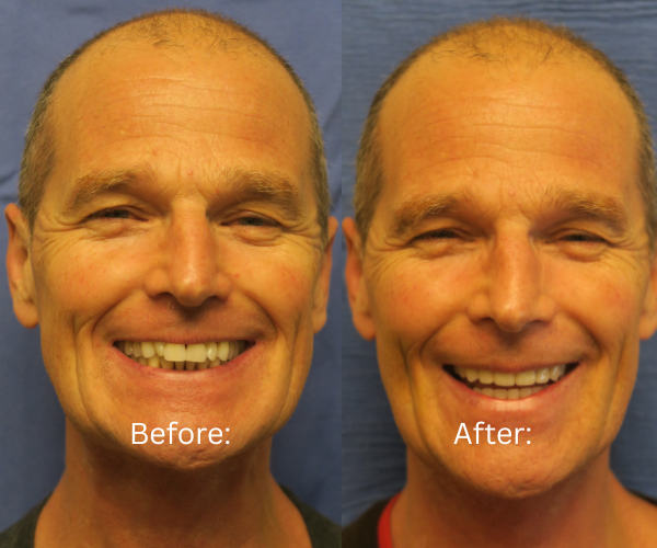 All-on-X before and after male patient