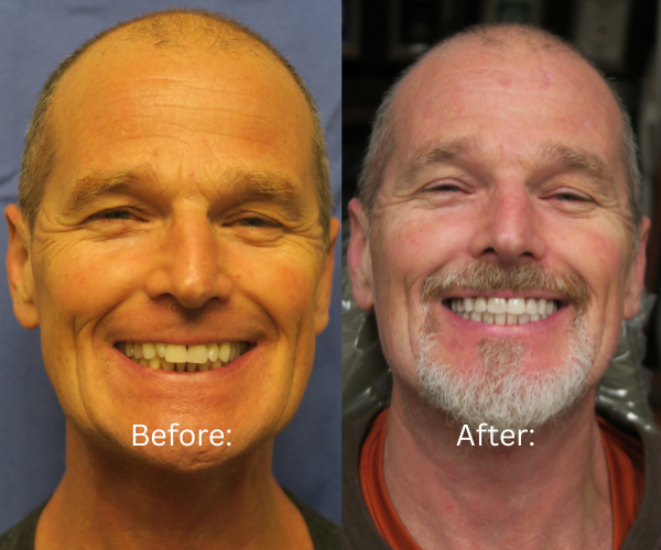 Smile transformation with All-on-X dental implants by Dr. Massoomi in Los Gatos