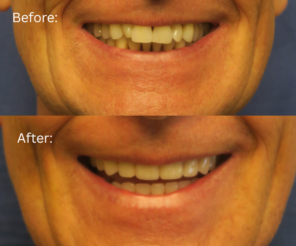 All-on-X before and after male patient