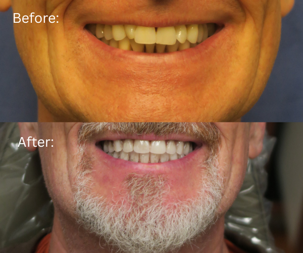Close up of Smile transformation with All-on-X dental implants by Dr. Massoomi in Los Gatos