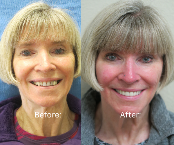 Before and after results of fixed full arch implants using All-on-X protocol