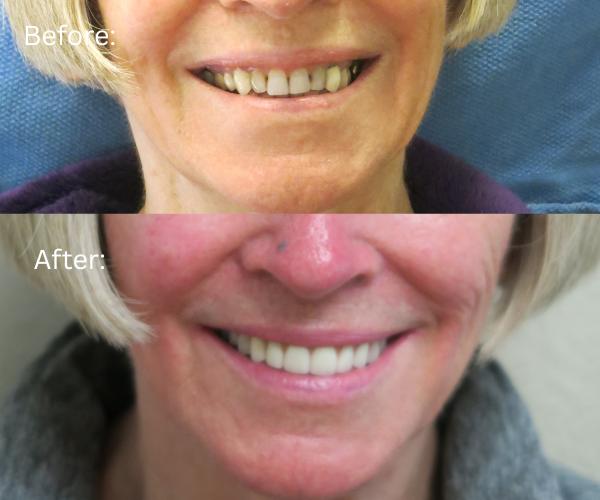Close up Before and after results of fixed full arch implants using All-on-X protocol