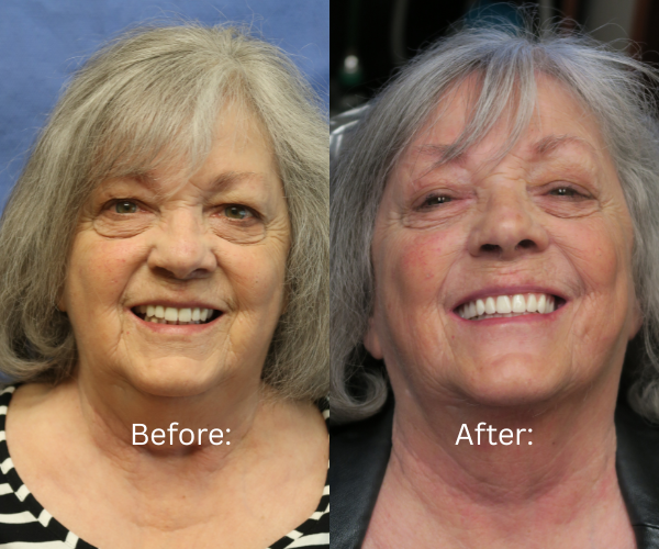 Bay Area Surgical Arts All-on-X case – smile rejuvenation from start to finish