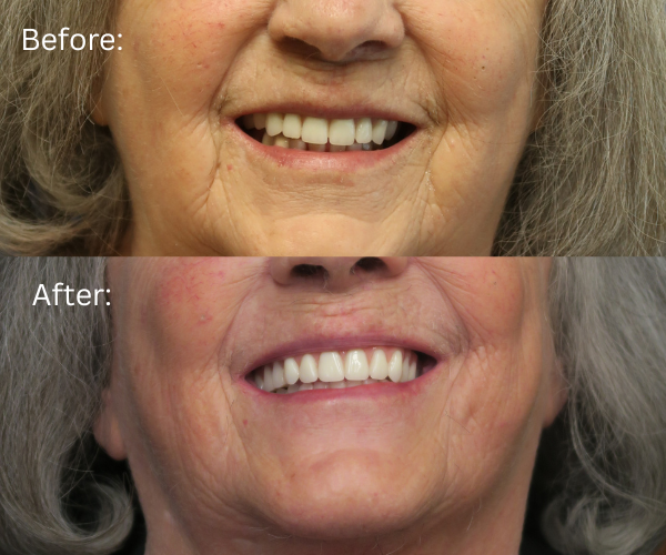 Bay Area Surgical Arts Close up of All-on-X case – smile rejuvenation from start to finish