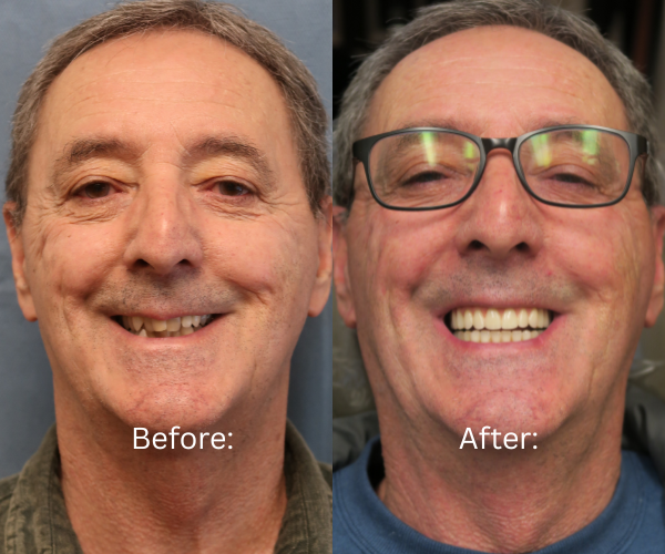 Patient’s teeth replaced with permanent All-on-X dental implants