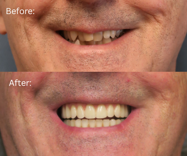 Close up of Patient’s teeth replaced with permanent All-on-X dental implants