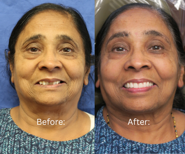 All-on-X implant results – natural-looking full arch restoration