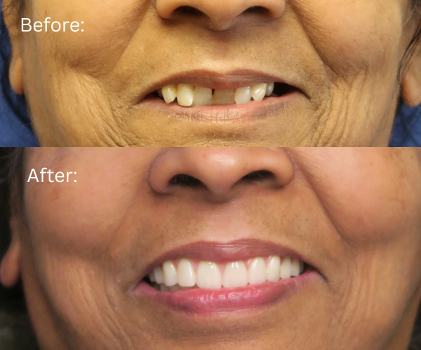 Close up of All-on-X implant results – natural-looking full arch restoration