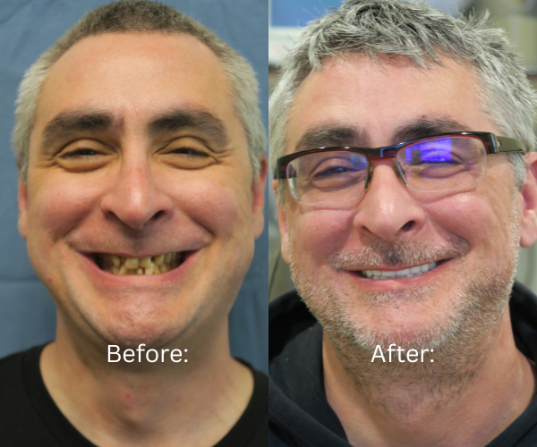 Before and after full mouth restoration by board-certified oral surgeon in the Bay Area