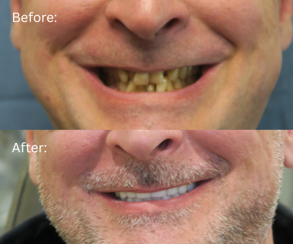 Close up Before and after full mouth restoration by board-certified oral surgeon in the Bay Area