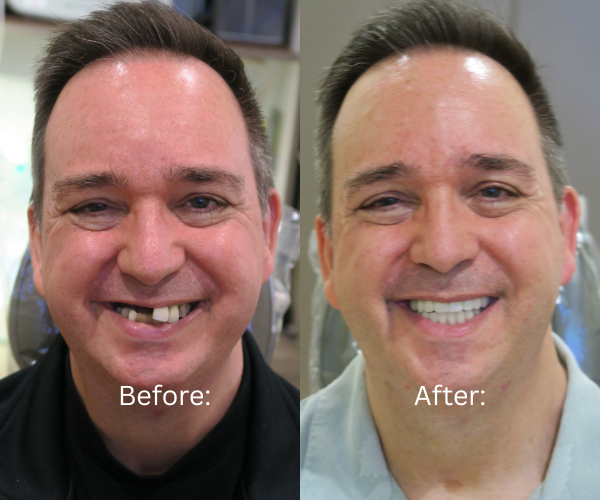 Life-changing dental implant makeover using the All-on-X technique