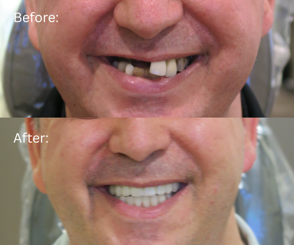 Close up of Life-changing dental implant makeover using the All-on-X technique
