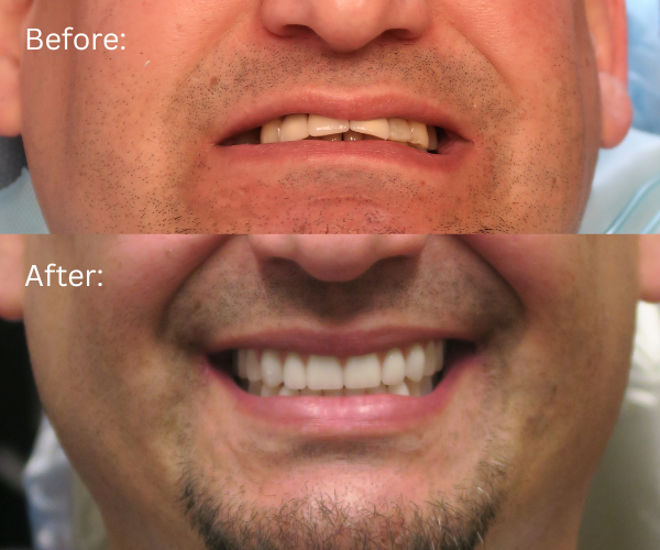 Close up of Patient smile restored with All-on-4 dental implants – before and after