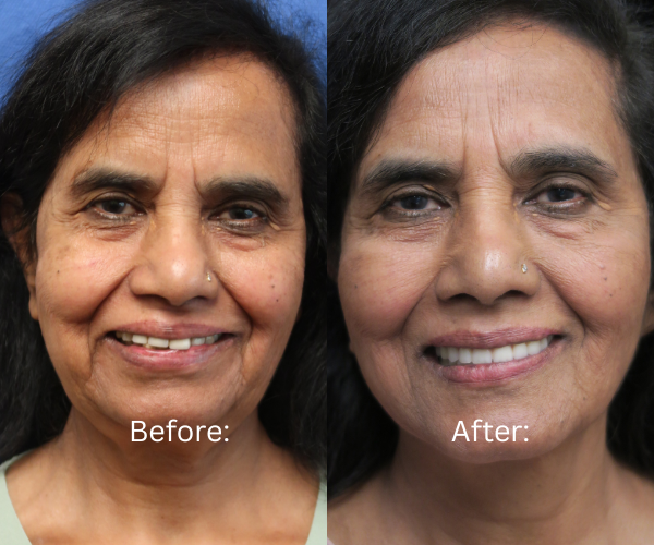 All-on-X transformation showing improved smile and facial structure