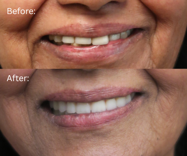Close up of All-on-X transformation showing improved smile and facial structure