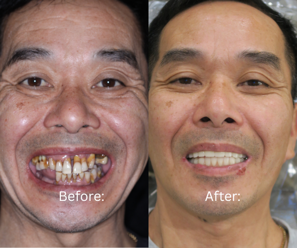 Before and after full arch dental implants by Dr. Nima Massoomi at Bay Area Surgical Arts