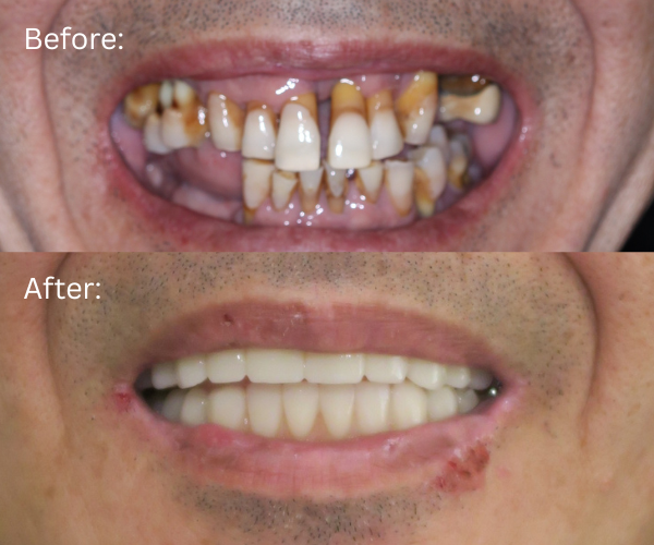 Close up Before and after full arch dental implants by Dr. Nima Massoomi at Bay Area Surgical Arts