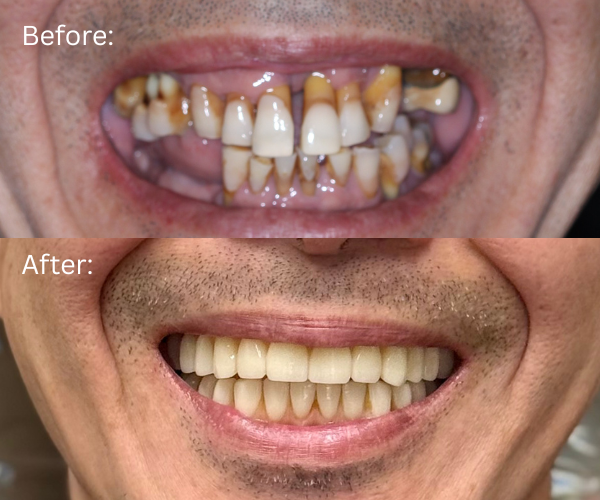 Close up Before and after full arch dental implants by Dr. Nima Massoomi at Bay Area Surgical Arts
